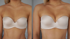 Upbra before and after