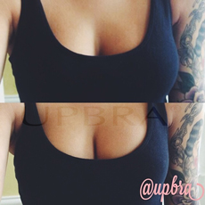 Upbra Lift up Bra before and after